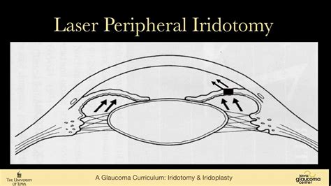 Iridotomy Iridoplasty YouTube