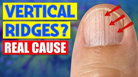 The Real Causes Behind Vertical Ridges On Nails Unveiled Youtube