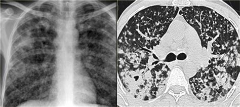 The Radiology Assistant Hrct Common Diagnoses