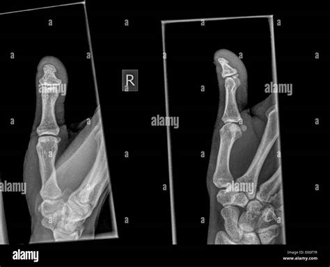 X-ray of a thumb with a broken distal phalanx Stock Photo - Alamy