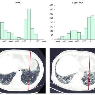 Interval Ct Images Of Year Old Man With Idiopathic Pulmonary