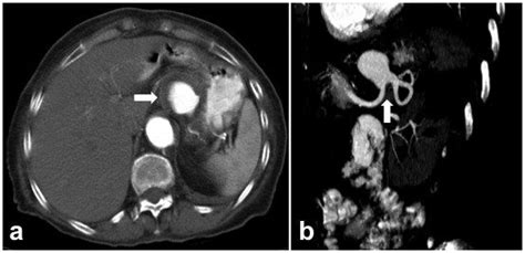 A Axial Contrast Material Enhanced Ct Angiogram Demonstrates A Cm