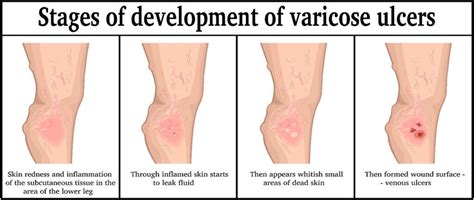 Deep Vein Thrombosis Center Ny Vein Treatment Center Medium