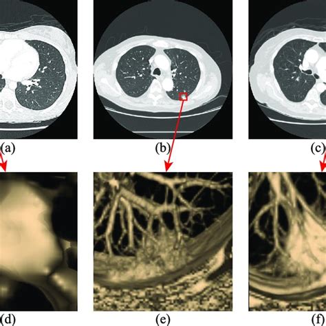 Three Types Of Lung Nodules A Isolated Nodule B 3d Image Of Download Scientific Diagram