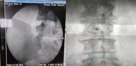 Some Of Our Interventional Procedures Ava Pain Intervention Center