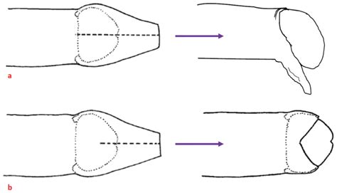 Types Of Circumcision Cuts