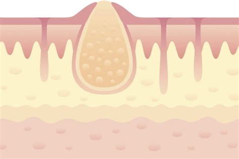 Top Causes of Boils - Health & Detox & Vitamins