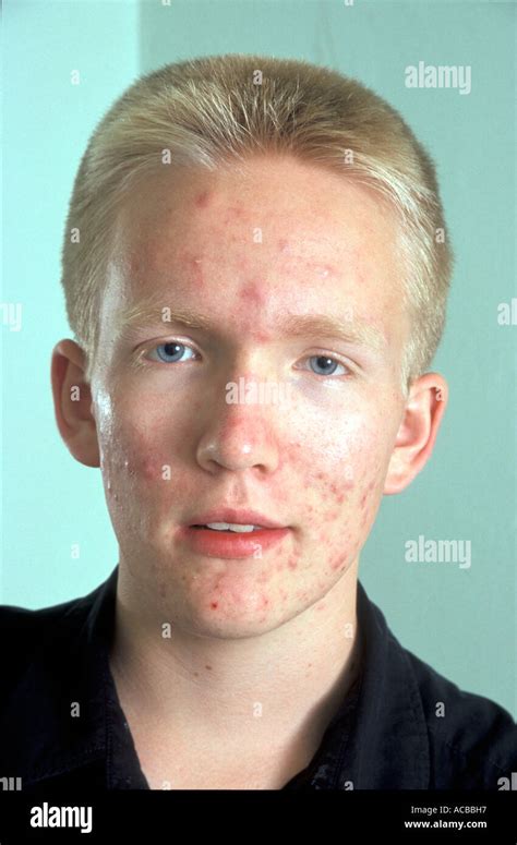 portrait blonde teenage boy  acne  face stock photo  alamy