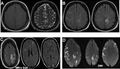 central nervous system vasculitis   glitters   gold