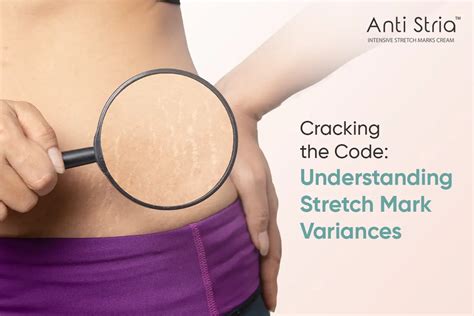 Stretch Marks Causes And Prevention Understanding The Science Anti Stria