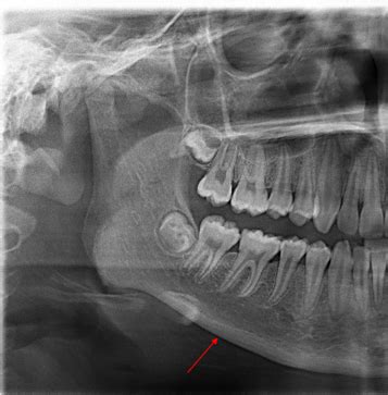 Anatomical Landmarks In Dental X Rays Flashcards Quizlet