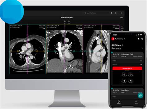 Medizinische Software PE RapidAI für Kliniken Diagnose Umform