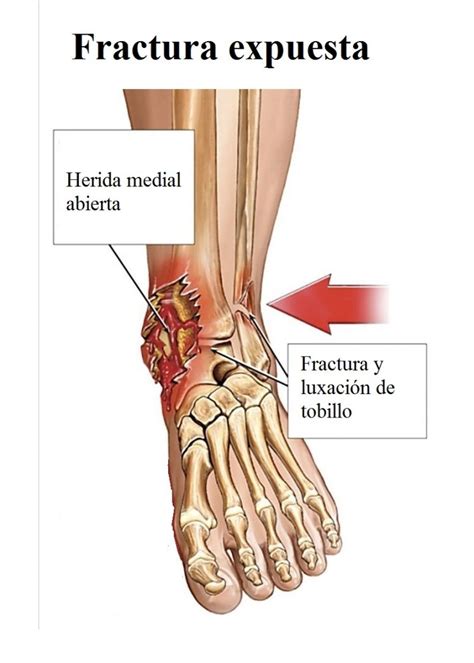 Fractura de peroné descubre aquí las causas síntomas y tratamientos