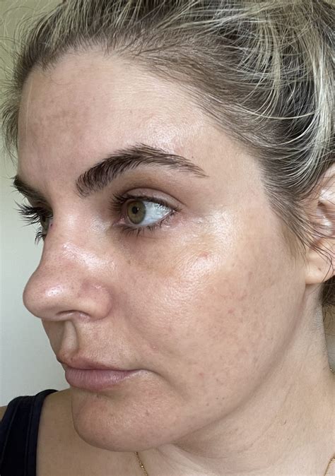 Im Trying Muselys Custom Prescription Skincare For My Melasma Acne