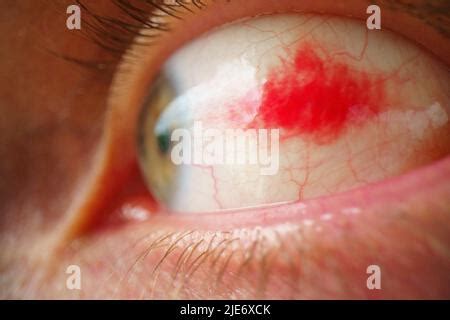 Subconjunctival Hemorrhage Hyposphagma Closeup Of Red Bloodshot Eye