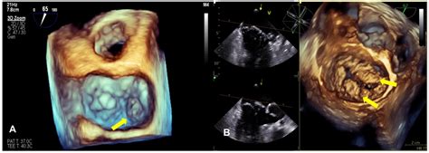 Diagnostics Free Full Text Arrhythmic Mitral Valve Prolapse A