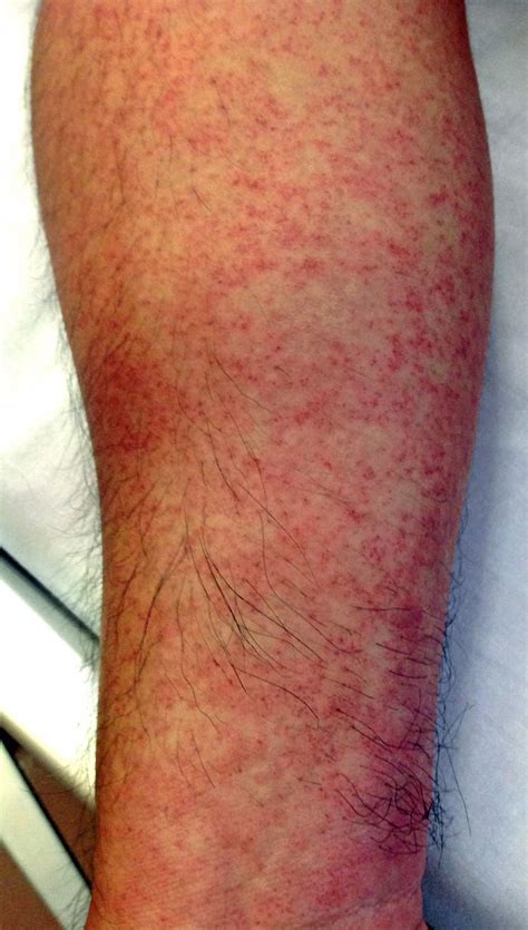 skin rash  dengue fever bmj case reports