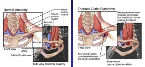 venous thoracic outlet syndrome shoulder pain differential diagnosis