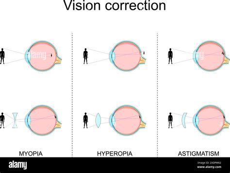 Vision Defects Myopia Hyperopia Astigmatism Vision Correction By
