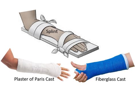 Fracture Casts And Splint