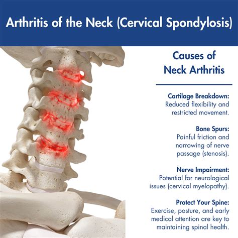 Arthritis Of The Neck Treatment Madison Wi Cervical Spondylosis Treatment Wisconsin