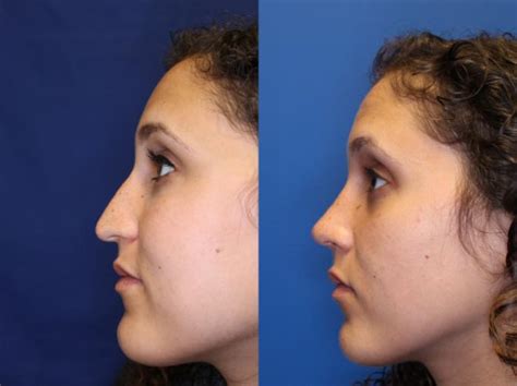 Nose Surgery Before And After Photo Gallery San Francisco Ca Kaiser Permanente Cosmetic Services