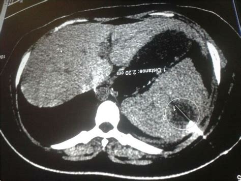 Ct Scan Of Abdomen Showing Enlarged Spleen With A Large Solitary Abscess Download Scientific