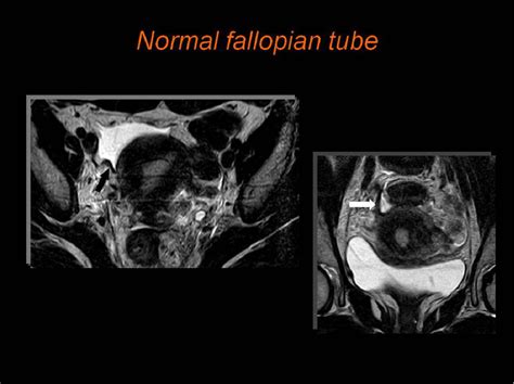 Figure 2 From Mr Imaging Findings In Fallopian Tube Diseases Semantic