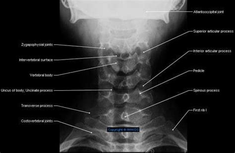 Cervical Vertebrae C I C VII Radiography Zygapophysial Joints