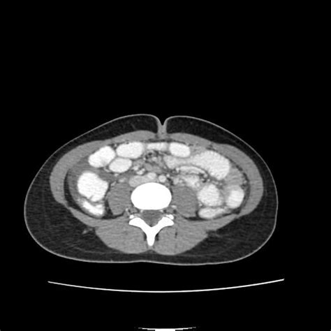 Perforated Appendicitis Image