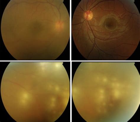 Uveitis In Behçet Disease In A Tertiary Center Over 25 Years The Kkesh