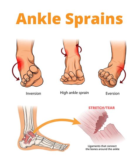 Premium Vector | Illustration of ankle sprains types