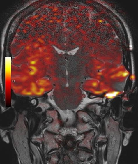 Cholesteatoma Radiology Reference Article