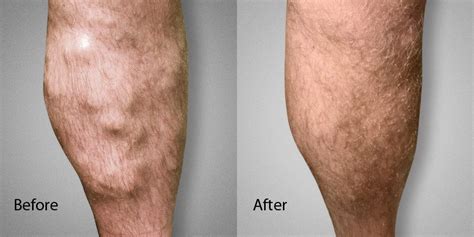 Before After Photos L Advanced Varicose Vein Treatments Of Manhattan NYC