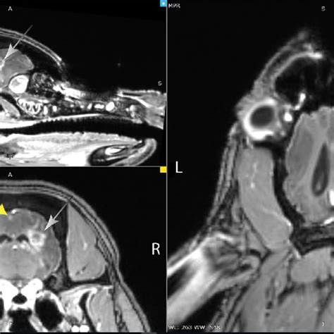 MRI (T1) with Gadoteric acid contrast showing changes in the grey ...