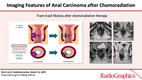 Imaging Features Of Anal Carcinoma After Chemoradiation RadioGraphics