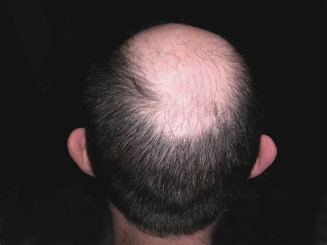 Hair Loss Explained How And Why Men Go Bald The Independent