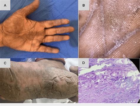 A Case Of Tinea Manuum And Tinea Pedis Showing Involvement Of One Hand Download Scientific