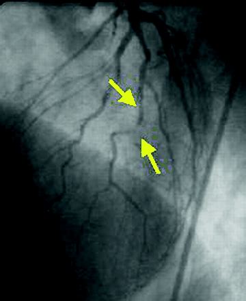 Percutaneous Coronary Intervention Ii The Procedure The Bmj