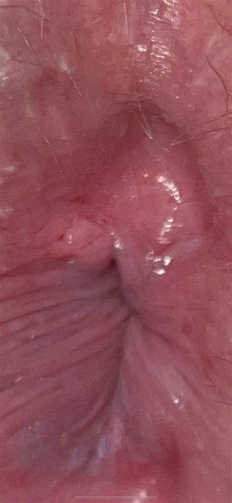 Nsfw Is This An Anal Fissure R Analfissures