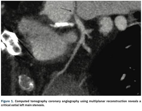 Synergy Megatron Drug Eluting Stent An Astute Solution To An Uncommon