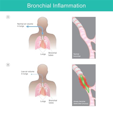 Premium Vector | Bronchial inflammation illustration explain bronchial inflammation from a virus ...