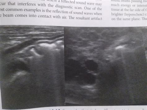 Ultrasound Flashcards Quizlet