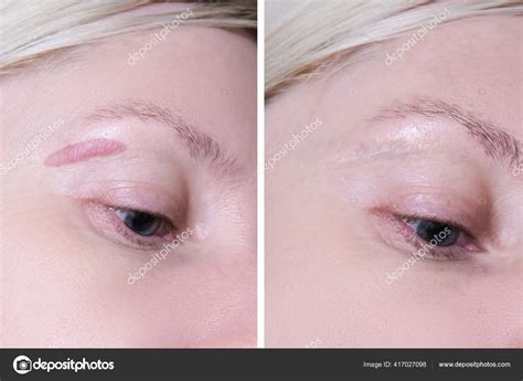 Cicatricure Queloide Antes E Depois - Cicatriz Queloide Hipertrófica Cara Mujer Antes Después Del Tratamiento ...