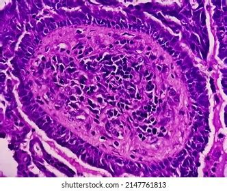 265 Endometrial hyperplasia Images, Stock Photos & Vectors | Shutterstock