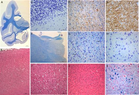 Neuropathological Features Of Scrapie Infected Cynomolgus Macaque A