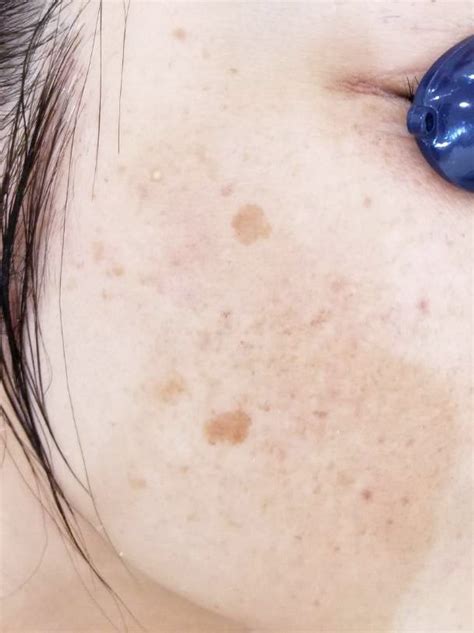 【シミ取りレーザー】治療の症例ご紹介♪ | Dr.高須 英津子のEle Beauty（エレ・ビューティー）