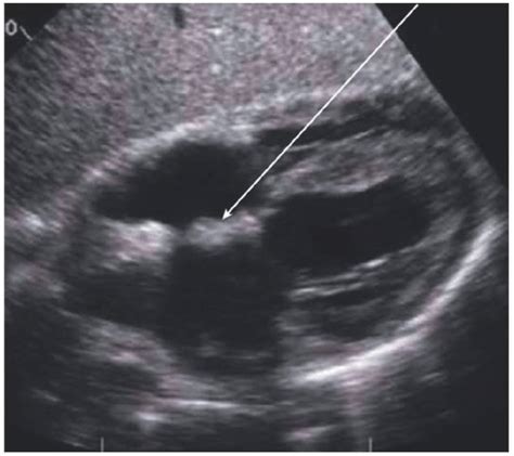 Endocarditis And Other Pathologic And Normal Anatomic Variants Thoracic Key