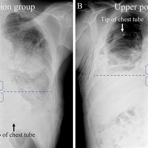 Chest X-ray highlighting the 9th and 10th thoracic vertebrae and the ...