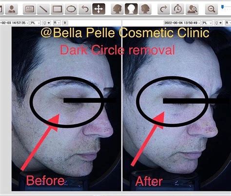 1 Dark Circles Treatment Clinic In Sydney Bella Pelle Cc